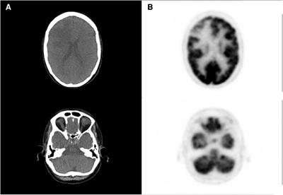 Case Report: Contribution of [18F]FET PET in differential diagnosis between radionecrosis and progression in metastasis—reproducibility and superiority of dynamic acquisitions